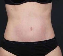 Tummy Tuck Before & After Patient #1270