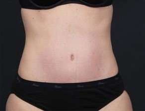 Tummy Tuck Before & After Patient #1270