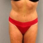 Tummy Tuck Before & After Patient #1277