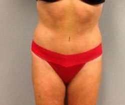 Tummy Tuck Before & After Patient #1277