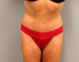 Tummy Tuck Before & After Patient #1277