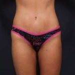 Tummy Tuck Before & After Patient #1284