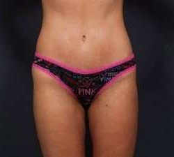 Tummy Tuck Before & After Patient #1284