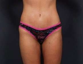 Tummy Tuck Before & After Patient #1284