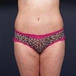 Tummy Tuck Before & After Patient #1289
