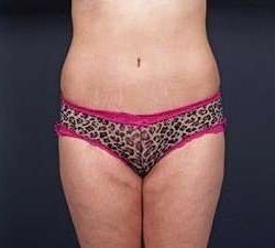 Tummy Tuck Before & After Patient #1289