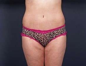 Tummy Tuck Before & After Patient #1289