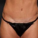 Tummy Tuck Before & After Patient #1296
