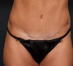 Tummy Tuck Before & After Patient #1296
