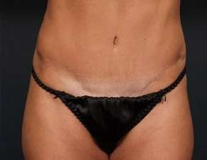 Tummy Tuck Before & After Patient #1296