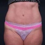 Tummy Tuck Before & After Patient #1303