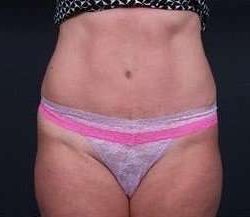 Tummy Tuck Before & After Patient #1303