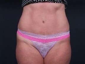 Tummy Tuck Before & After Patient #1303