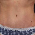 Tummy Tuck Before & After Patient #1310