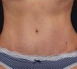 Tummy Tuck Before & After Patient #1310