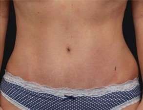 Tummy Tuck Before & After Patient #1310