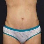 Tummy Tuck Before & After Patient #1315