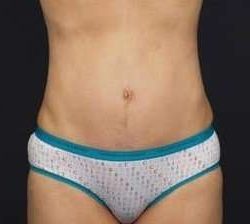 Tummy Tuck Before & After Patient #1315
