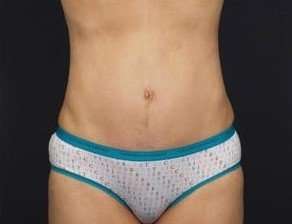 Tummy Tuck Before & After Patient #1315