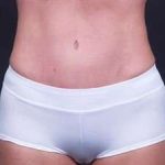 Tummy Tuck Before & After Patient #1322