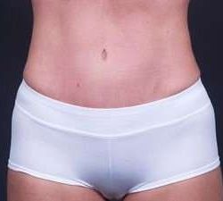 Tummy Tuck Before & After Patient #1322
