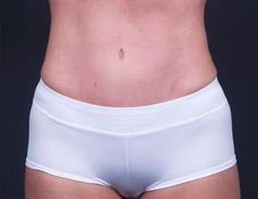 Tummy Tuck Before & After Patient #1322