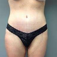 Tummy Tuck Before & After Patient #1327