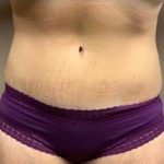 Tummy Tuck Before & After Patient #1332