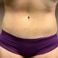Tummy Tuck Before & After Patient #1332