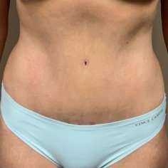 Tummy Tuck Before & After Patient #1337