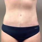 Tummy Tuck Before & After Patient #1349