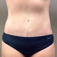 Tummy Tuck Before & After Patient #1349