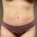 Tummy Tuck Before & After Patient #1354