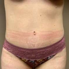 Tummy Tuck Before & After Patient #1354