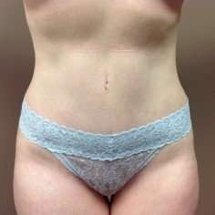 Tummy Tuck Before & After Patient #1359