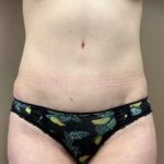 Tummy Tuck Before & After Patient #1364