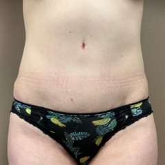 Tummy Tuck Before & After Patient #1364