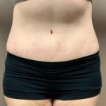 Tummy Tuck Before & After Patient #1371