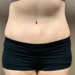Tummy Tuck Before & After Patient #1371