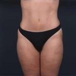 Tummy Tuck Before & After Patient #1378