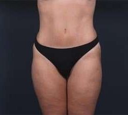 Tummy Tuck Before & After Patient #1378