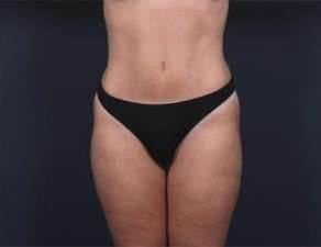 Tummy Tuck Before & After Patient #1378