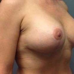 Mommy Makeover Before & After Patient #1395