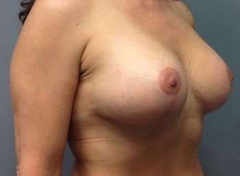 Mommy Makeover Before & After Patient #1395