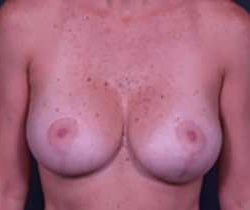 Breast Mastopexy Before & After Patient #197