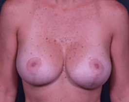 Breast Mastopexy Before & After Patient #197