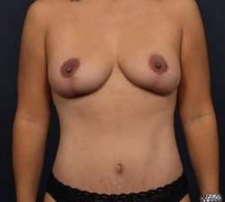 Mommy Makeover Before & After Patient #1423