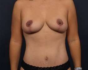 Mommy Makeover Before & After Patient #1423
