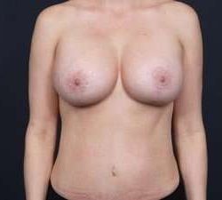 Mommy Makeover Before & After Patient #1435
