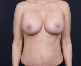 Mommy Makeover Before & After Patient #1435